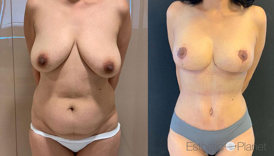 mommymakeover