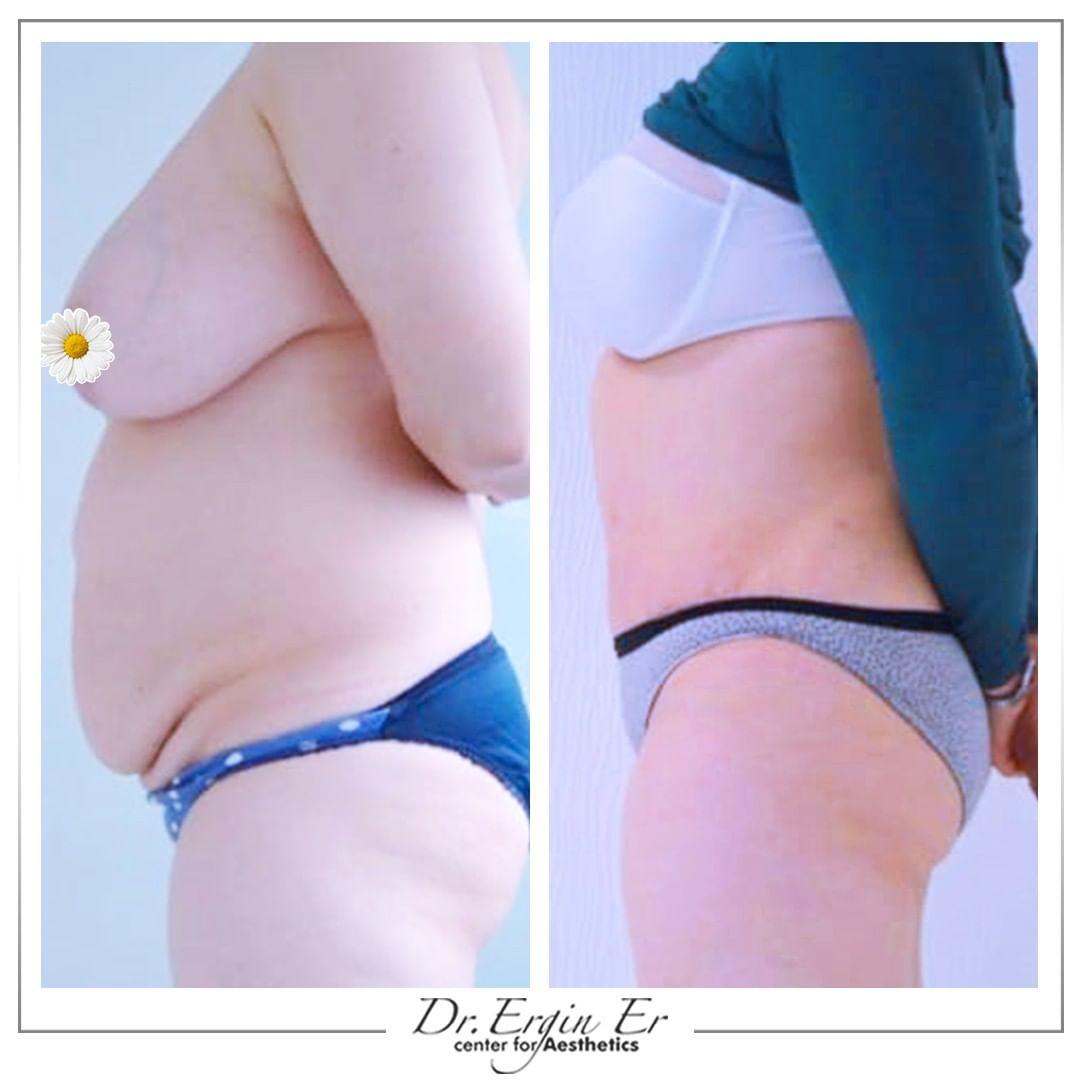 abdominoplastie2