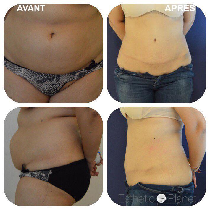 abdominoplastie1-min