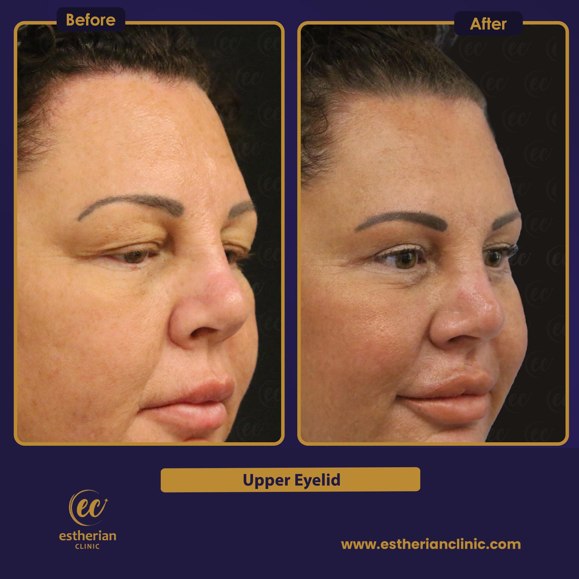 Blepharoplastie UPPER EYELID Turkey 3