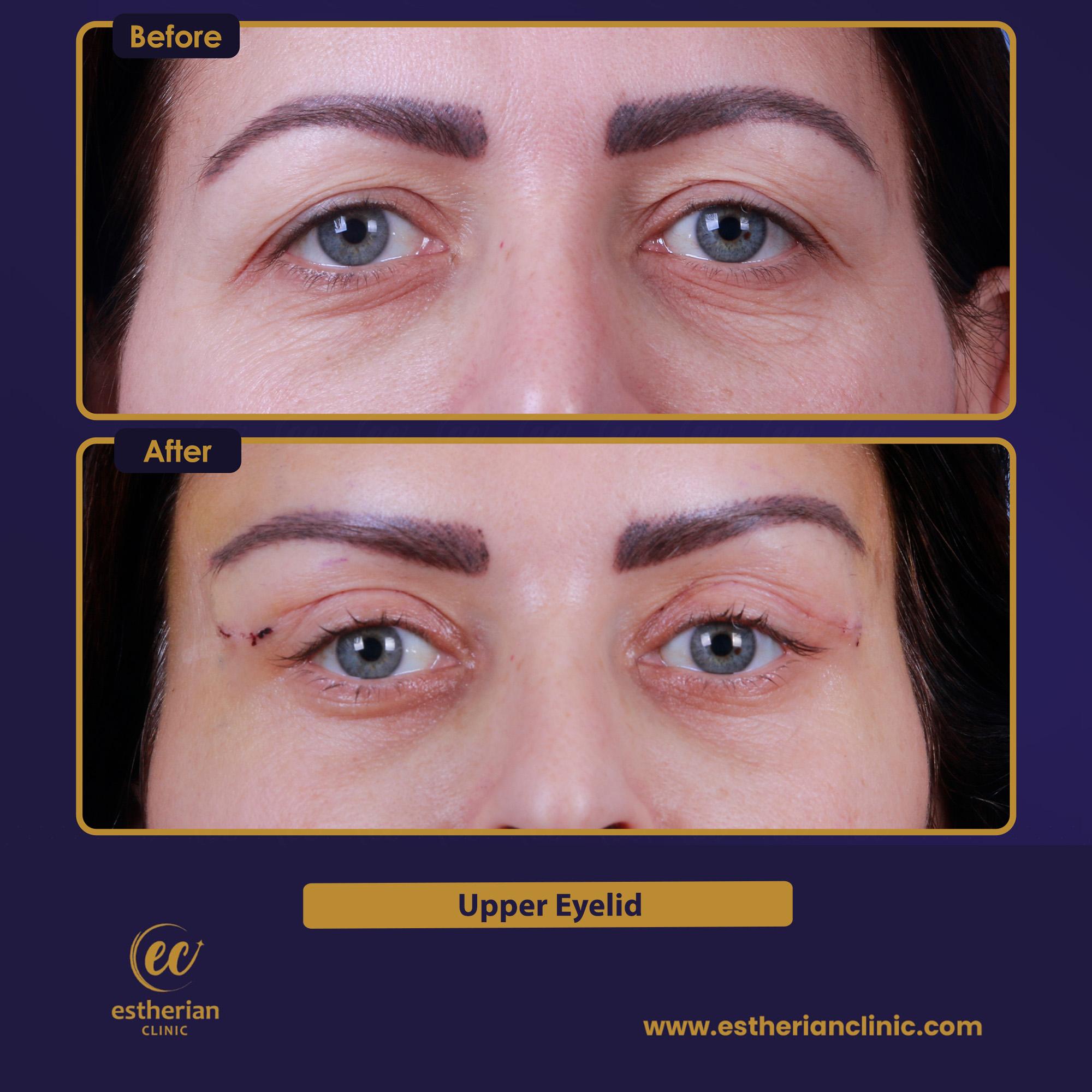 Blepharoplastie UPPER EYELID Turkey 1
