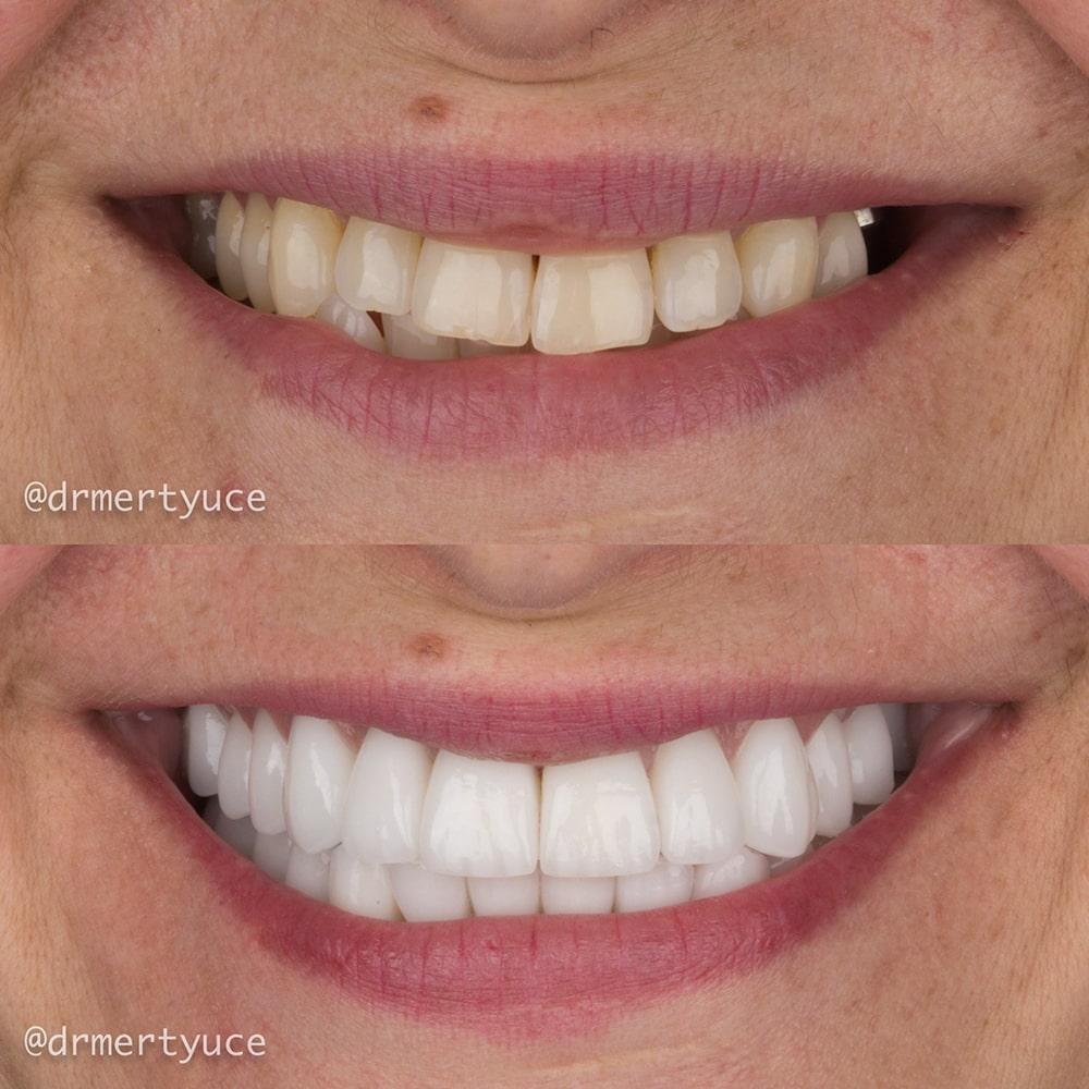 Veneers by Dentaglobal 
