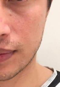 Beard transplant FUE Istanbul turkey 