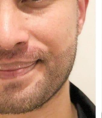 Beard transplant FUE Istanbul turkey 