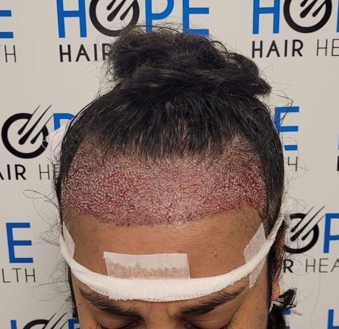 FUE feminine Istanbul turkey 