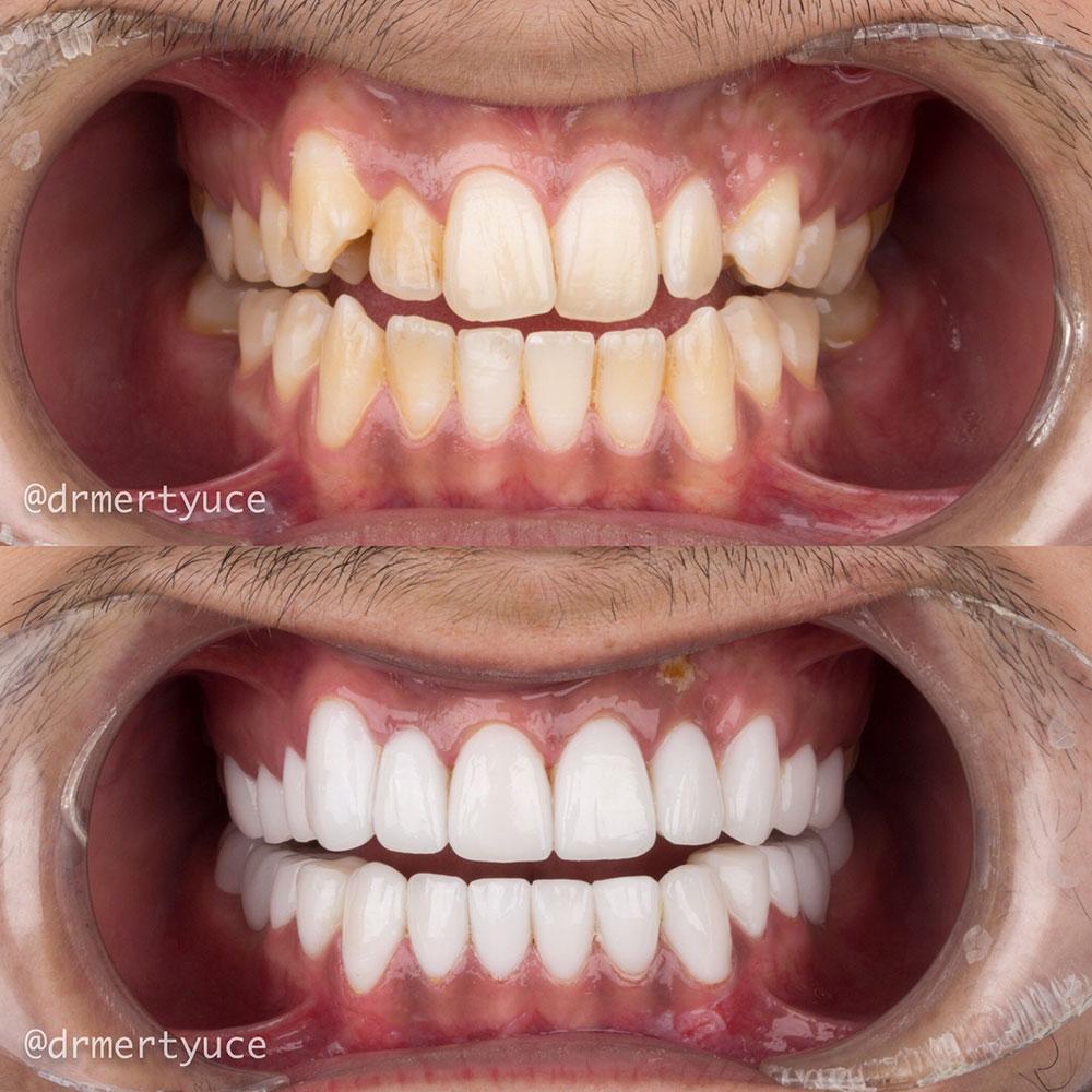 Veneers by Dentaglobal 
