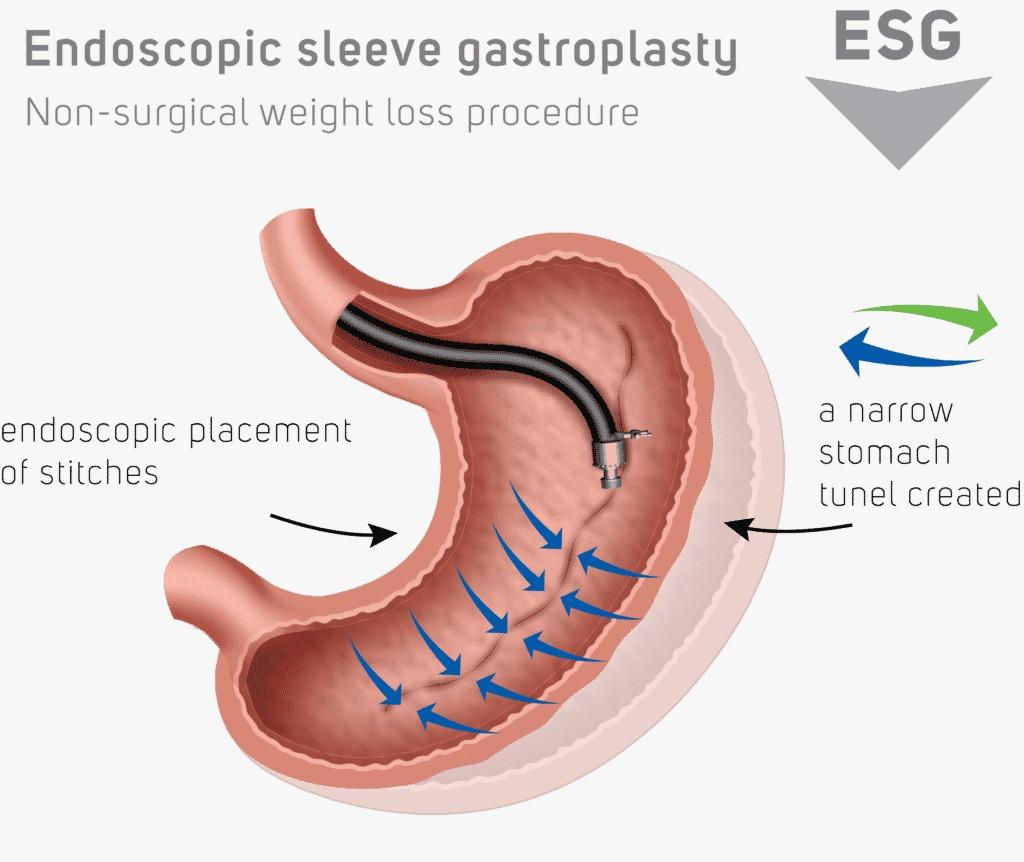 EndoSleeve in poland