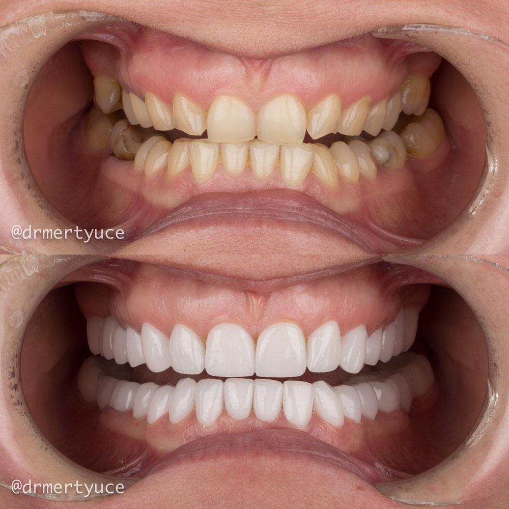 Veneers by Dentaglobal 