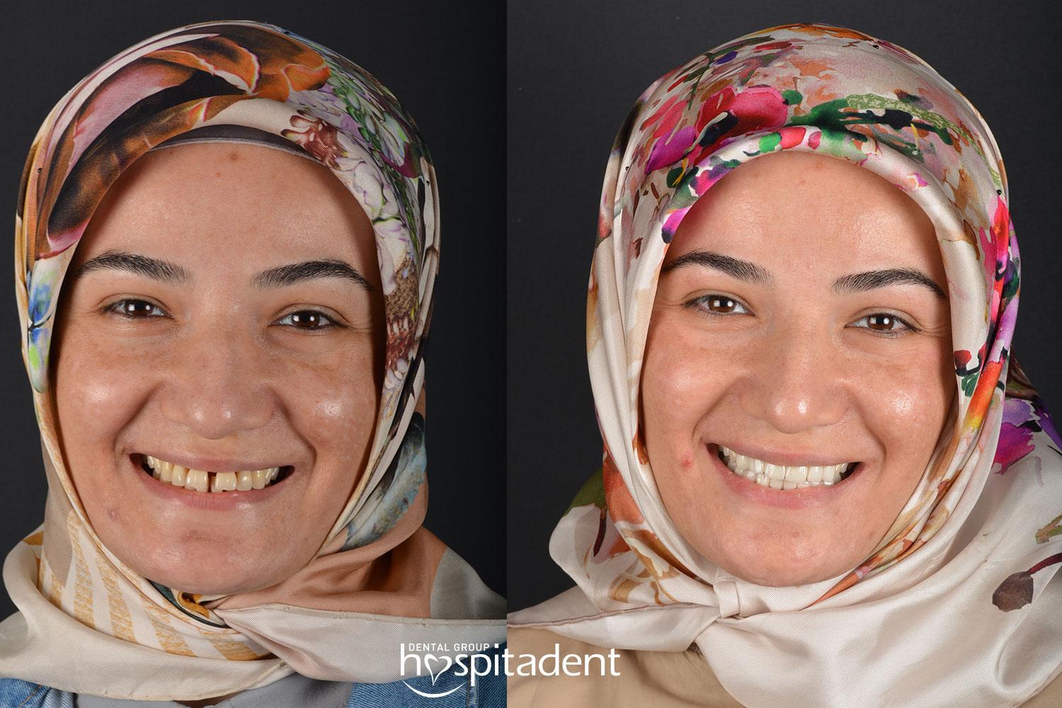 Facettes Dentaires // Dental Veneers