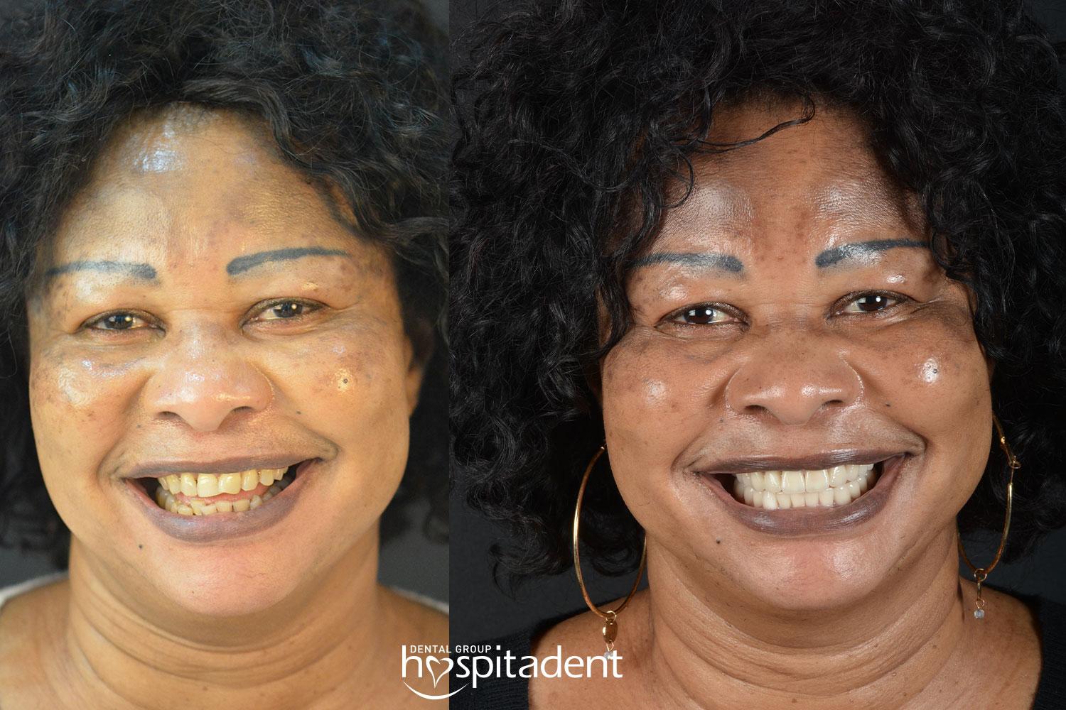 Facettes Dentaires // Dental Veneers