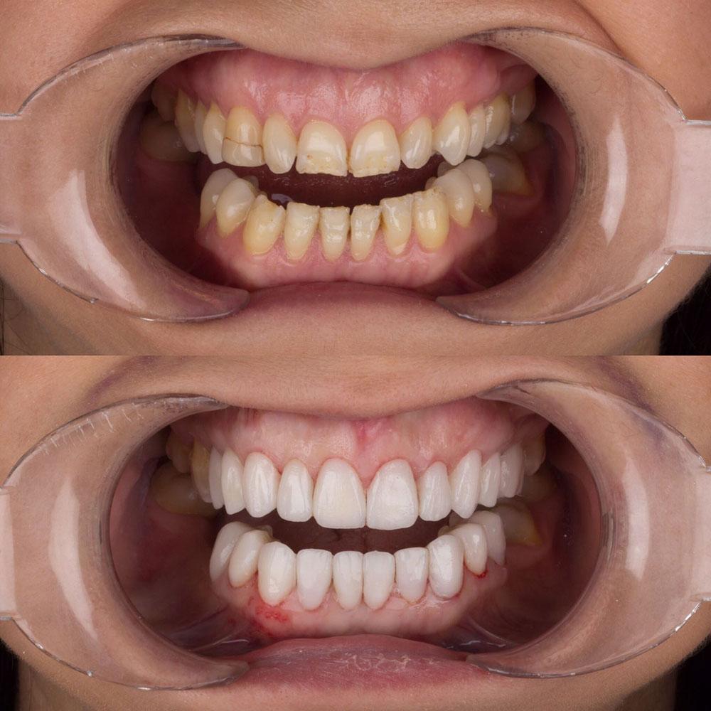 Veneers by Dentaglobal 