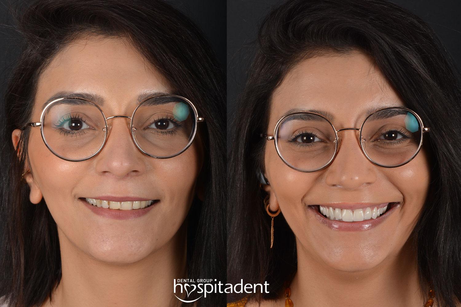 Facettes Dentaires // Dental Veneers