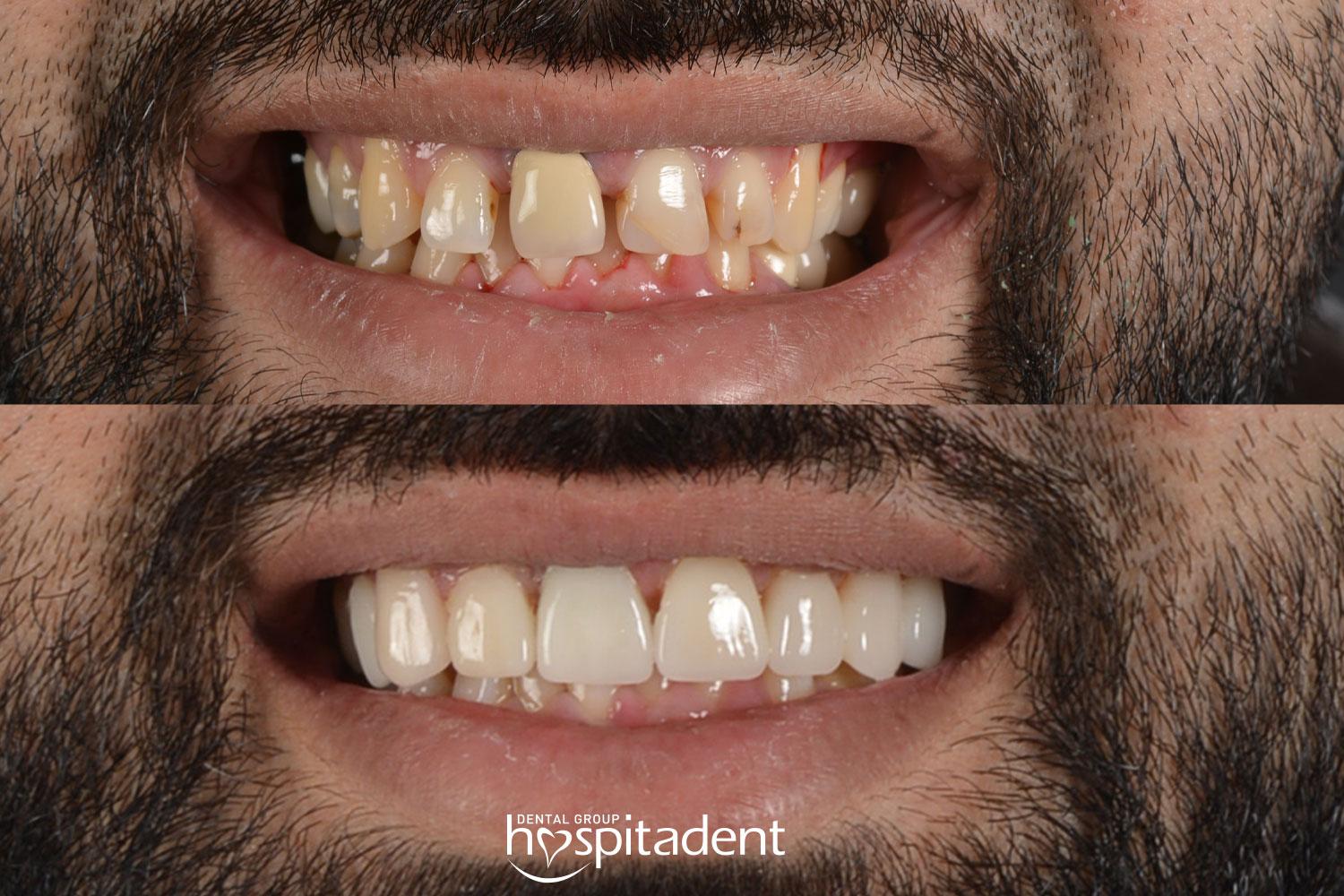 Facettes Dentaires // Dental Veneers