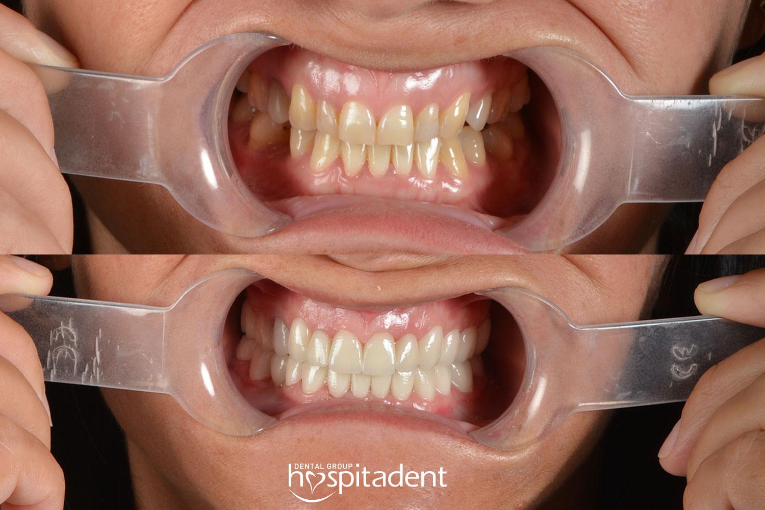 Facettes Dentaires // Dental Veneers