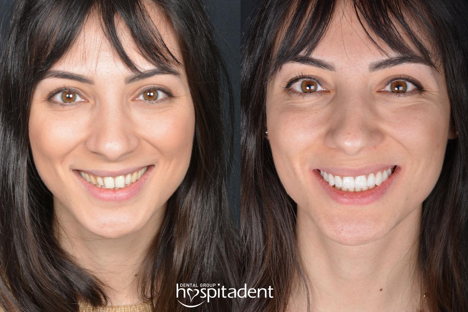 Facettes Dentaires // Dental Veneers