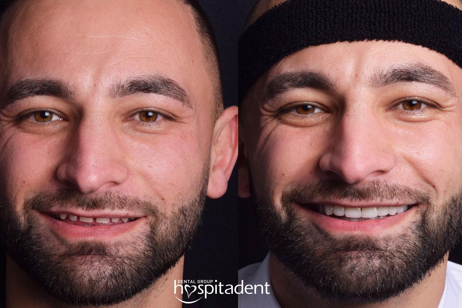 Facettes Dentaires // Dental Veneers