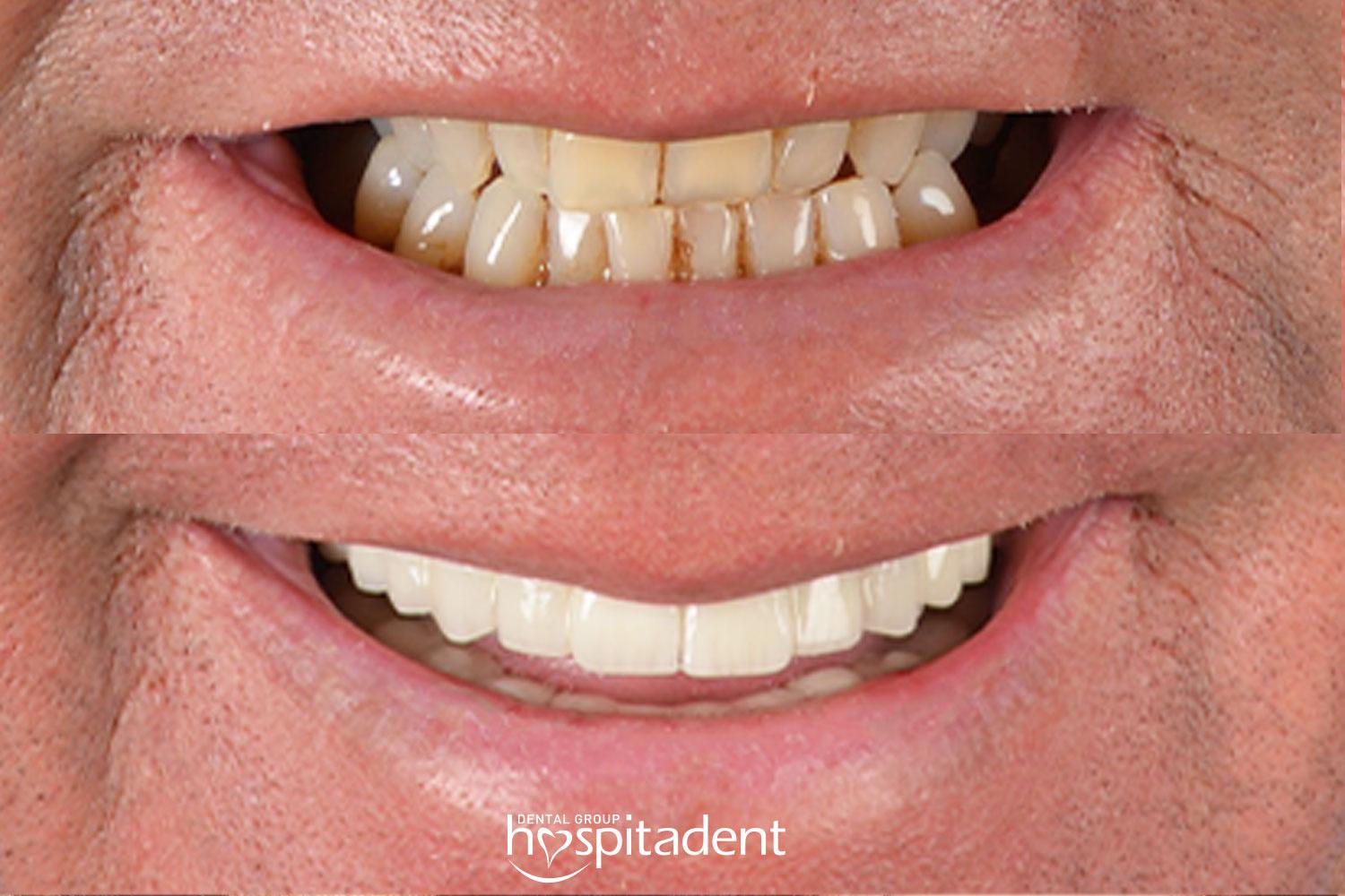 Dental Zirconium crown13