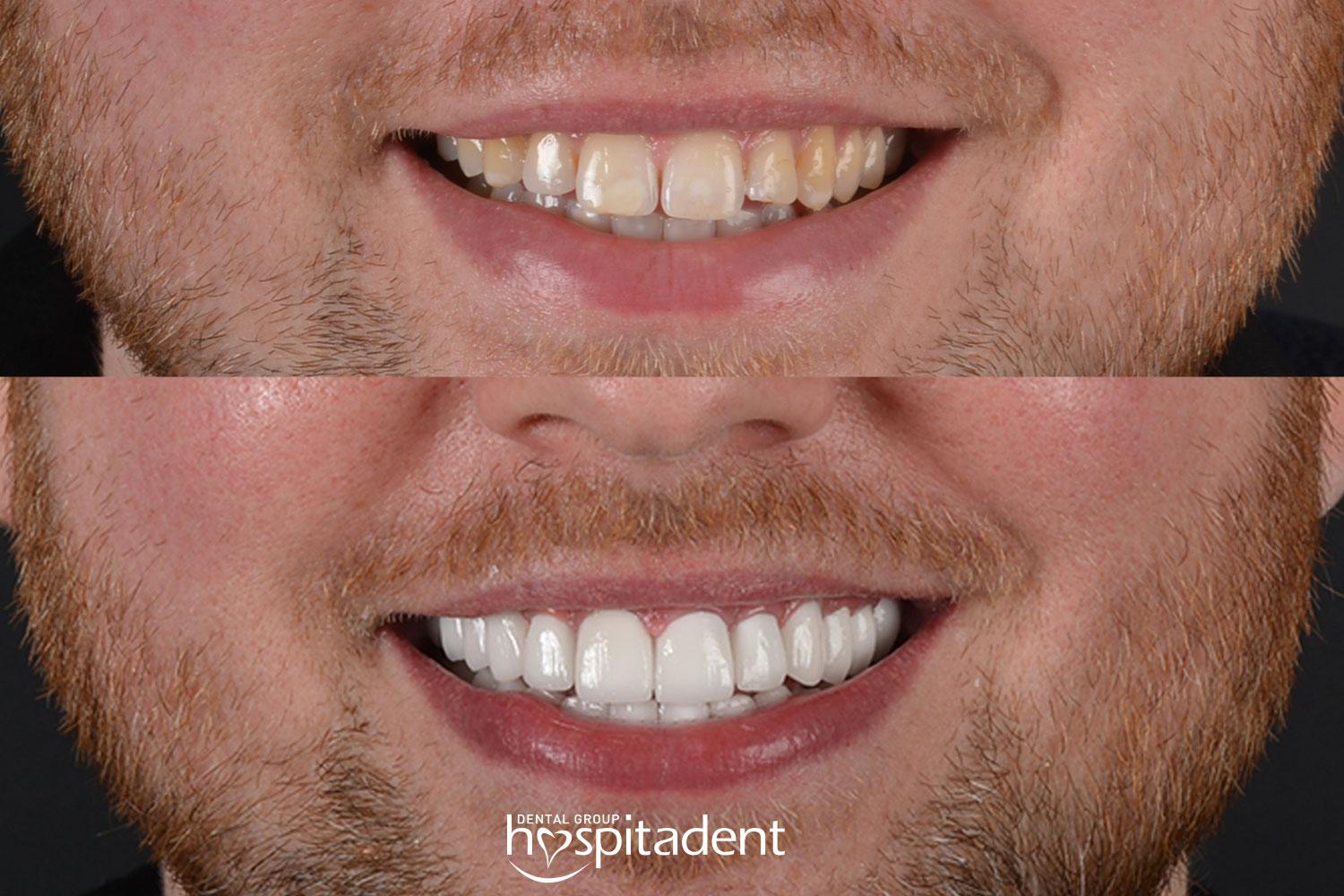 Dental Zirconium crown1