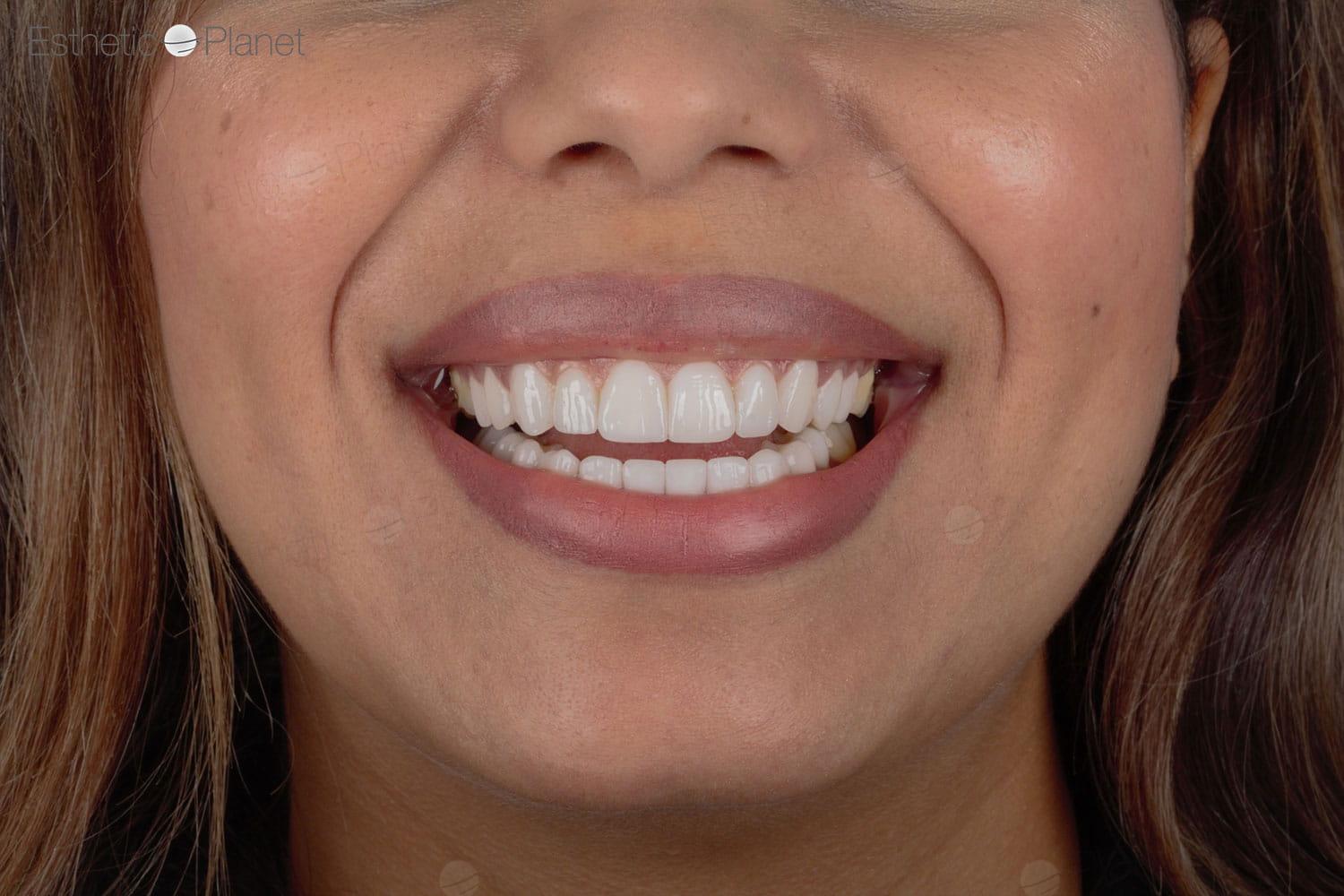 Veneers by Dentaglobal 