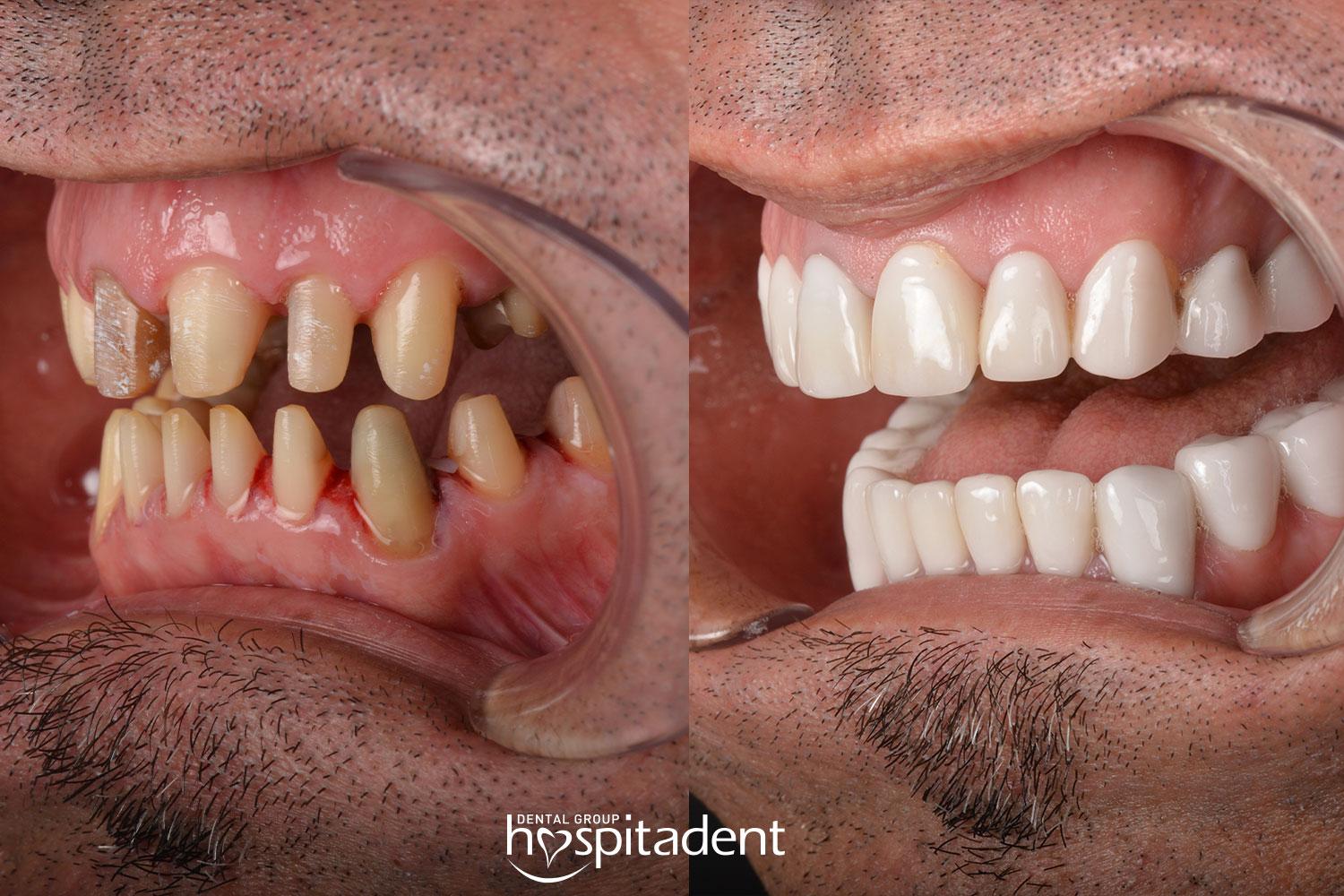 Dental Zirconium crown10