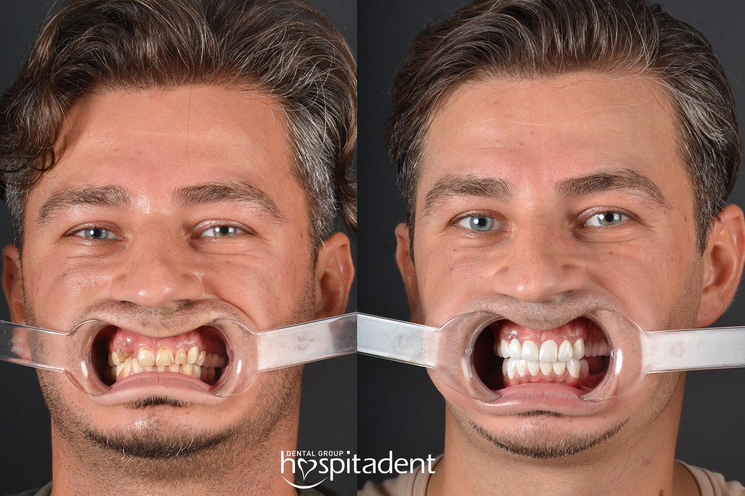 Dental Zirconium crown3