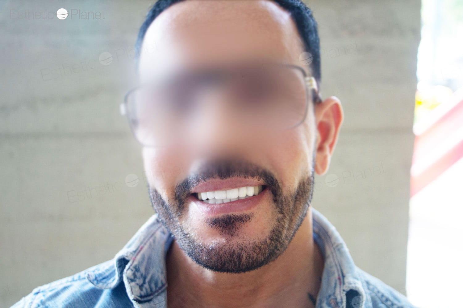 Veneers by Dentaglobal 