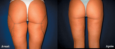 Liposuccion : les différents types de liposuccions