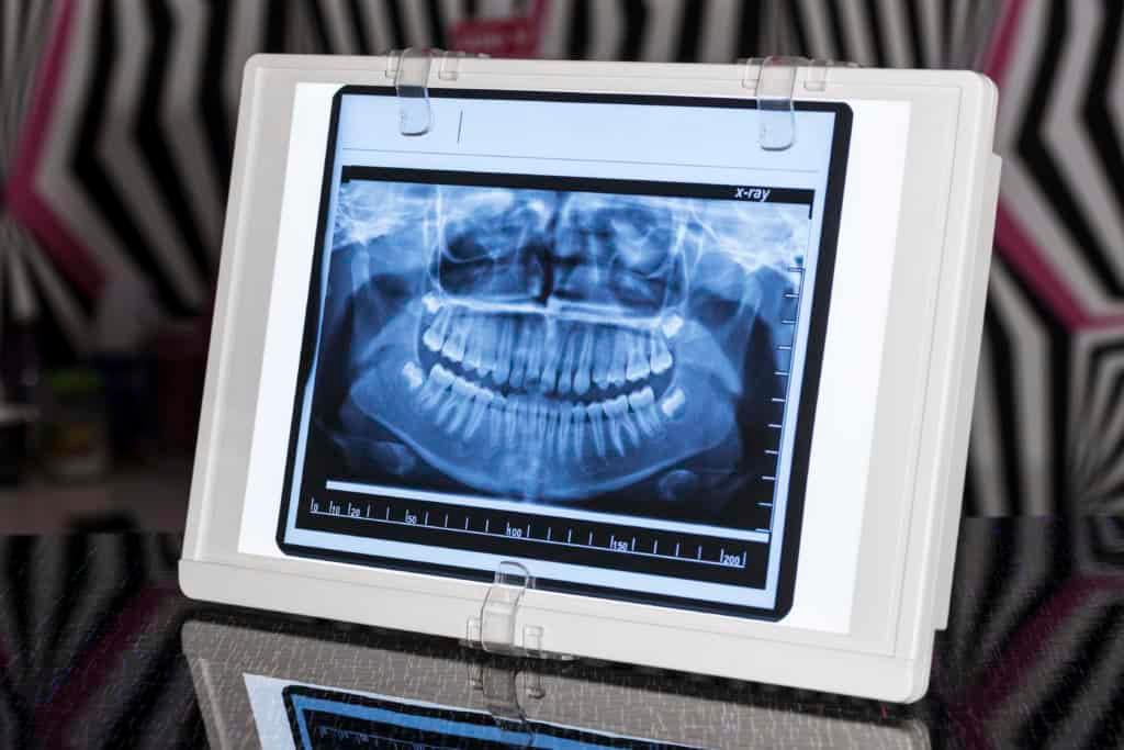 come ottenere una radiografia panoramica dentale