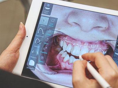 Guida alle faccette dentali