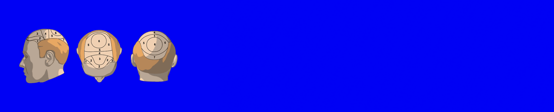 Hair transplant simulator set density and placement banner