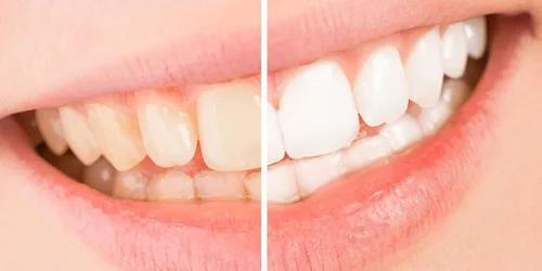 Blanqueamiento dental