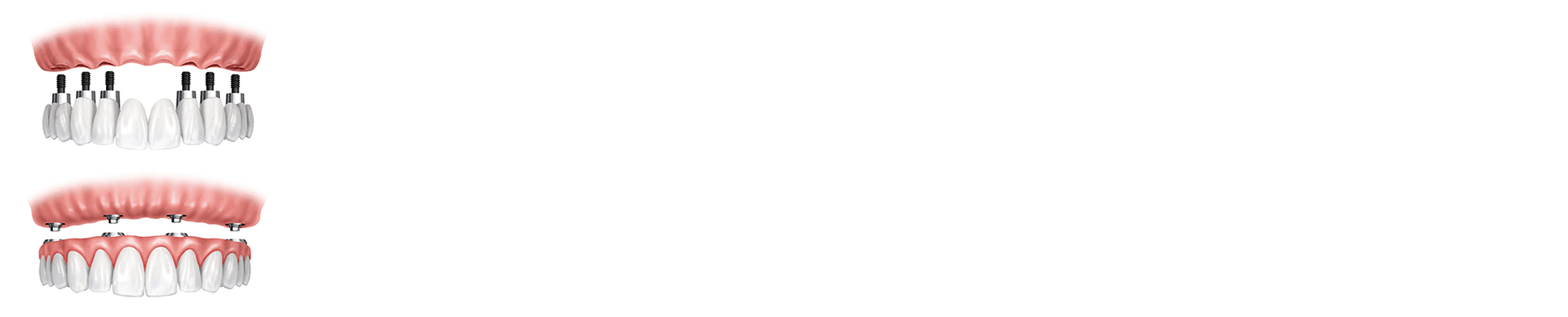 Total jaw reconstruction banner