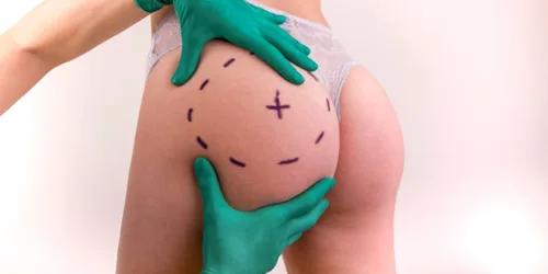 Implants fessiers