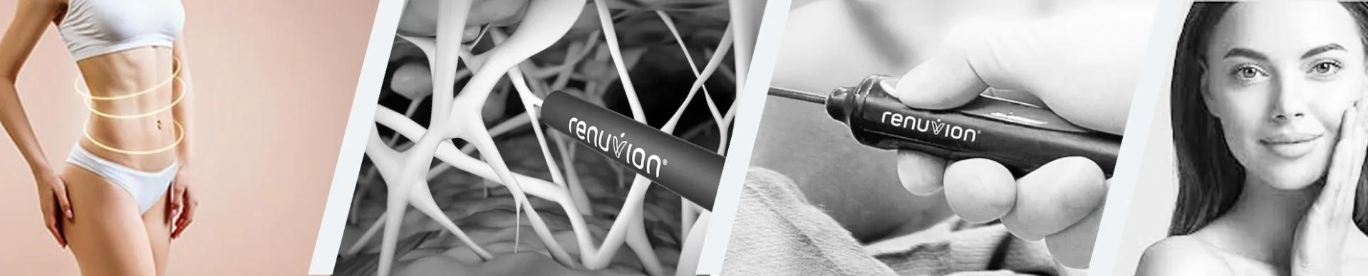 J Plasma Renuvion — Esthetic Planet