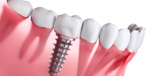 Implants Dentaires