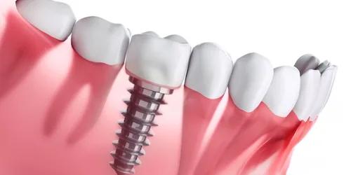 Implantes dentales