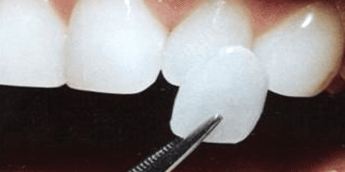 Facettes Pelliculaires