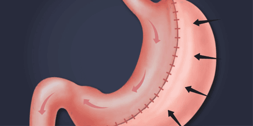 Revision Sleeve ( Re Sleeve)