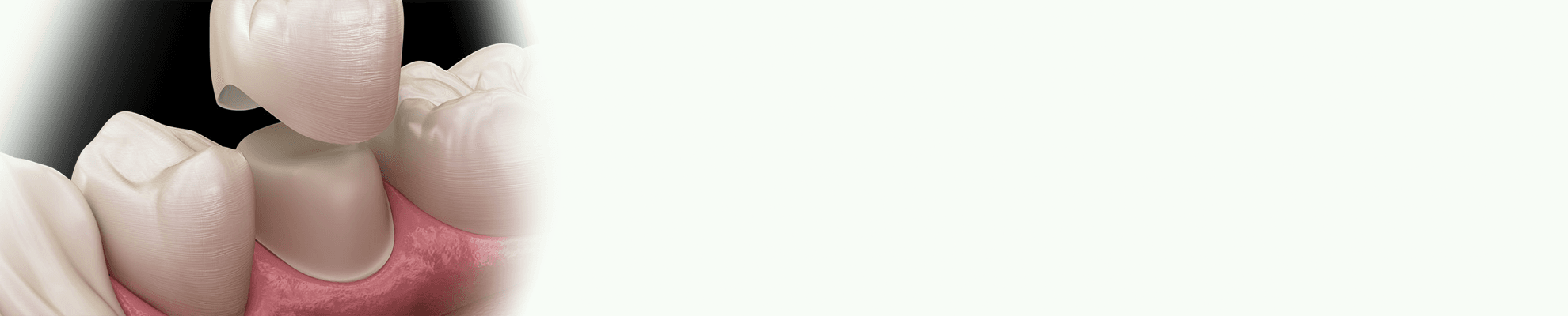 Couronnes Zircones banner