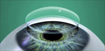 Cheratoplastica, trapianto di cornea