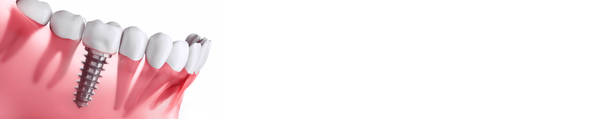 Dental implants banner