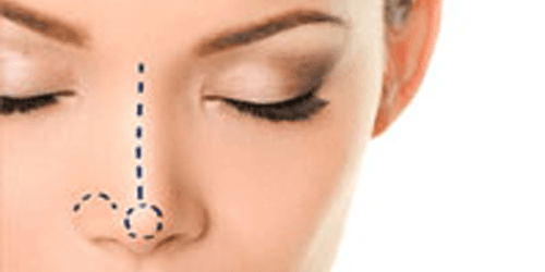 Rhinoplastie Classique