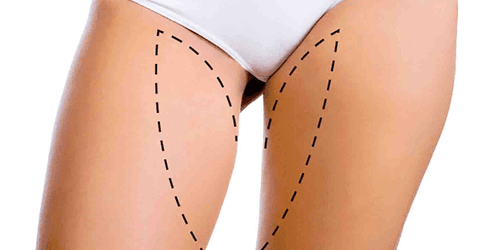 Lifting des cuisses
