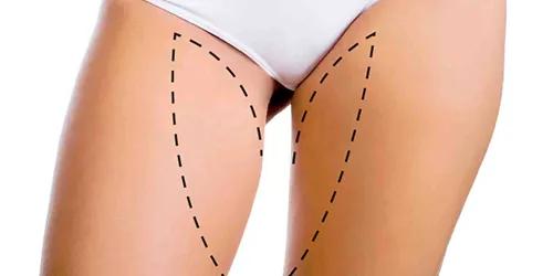 Lifting delle cosce