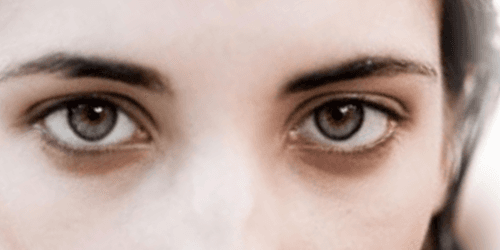 Blefaroplastica superiori o inferiori