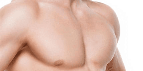 Gynecomastie