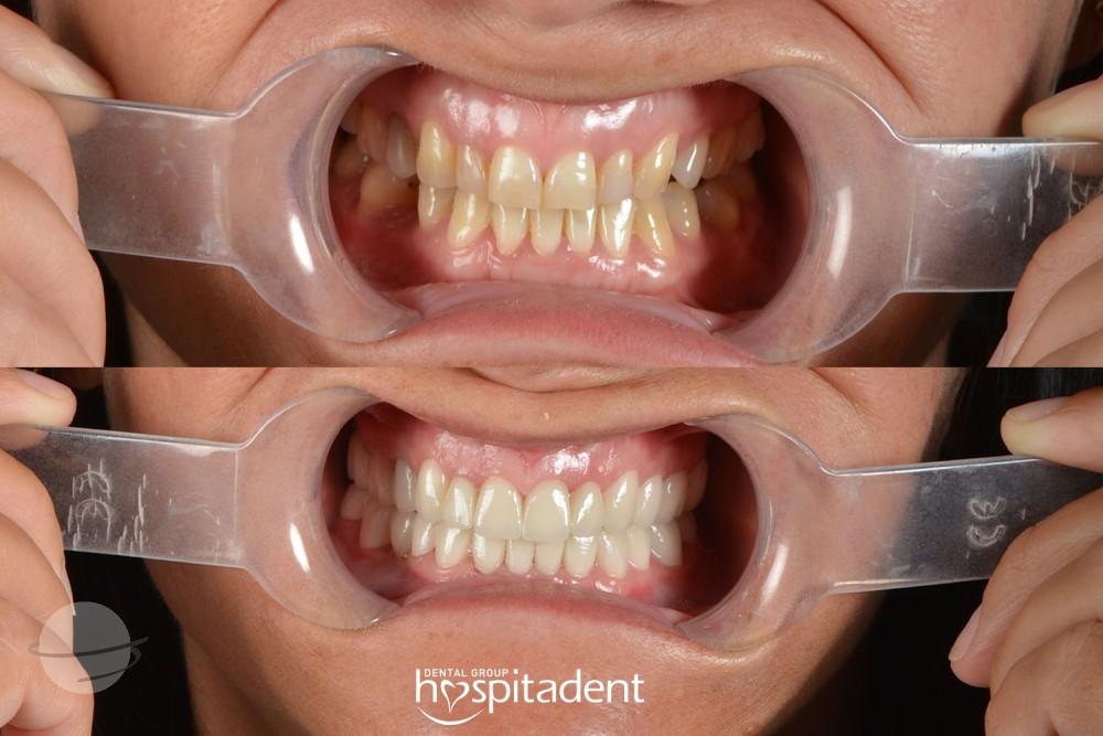 Dental Zirconium crown4