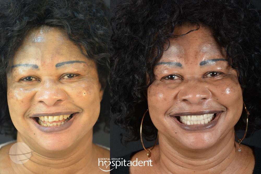 Dental Zirconium crown5