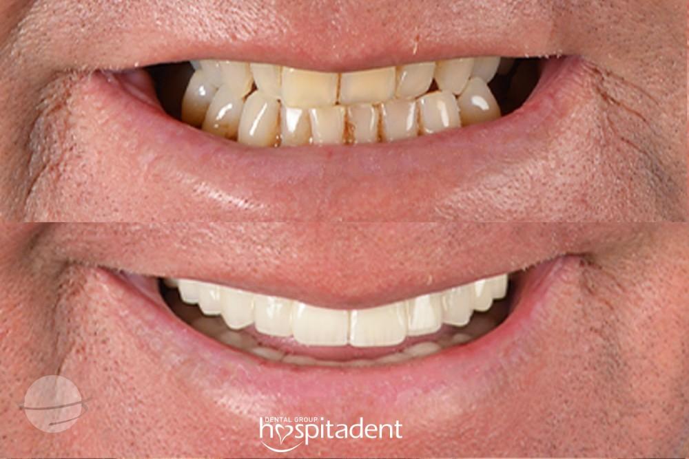 Dental Zirconium crown13