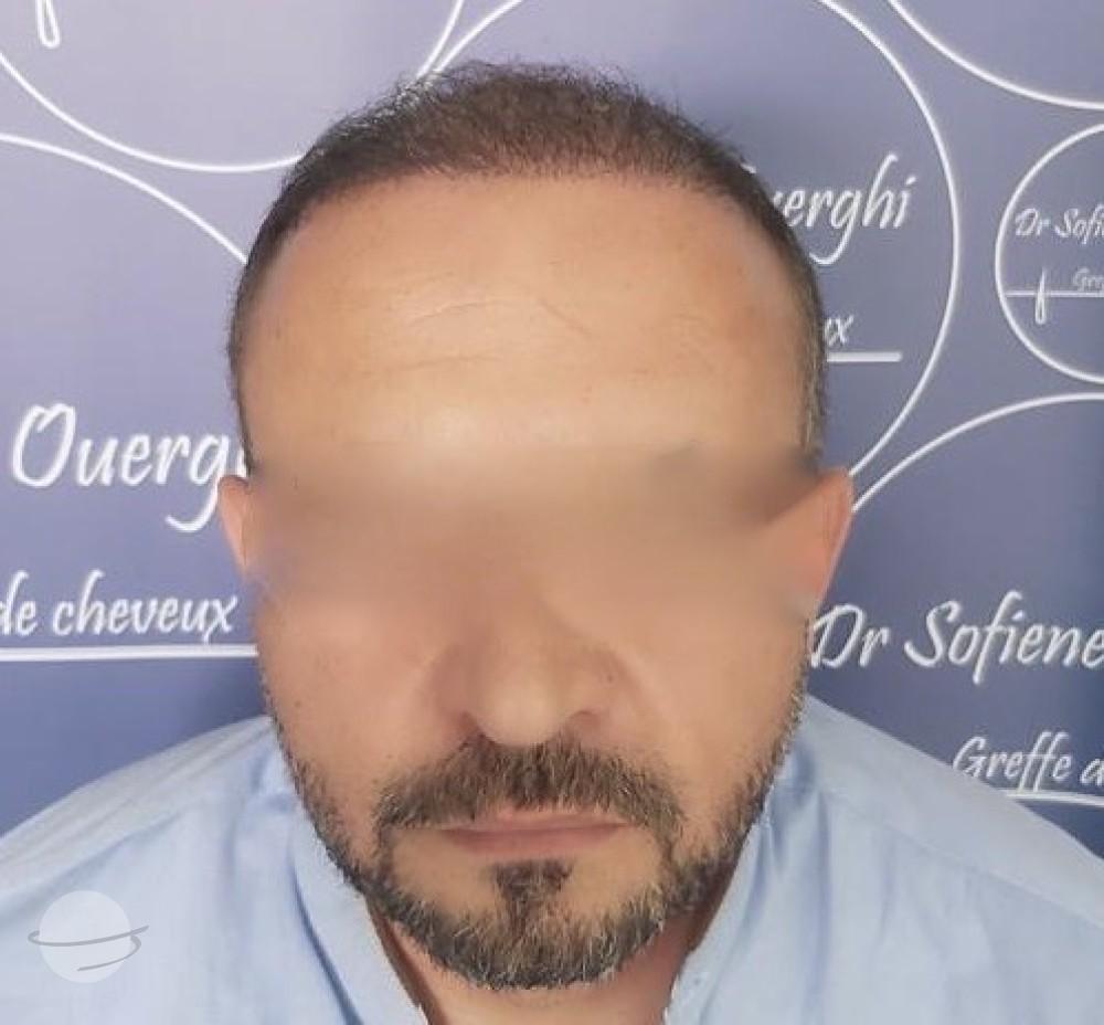 Dr Sofiene Ouerghi before : after11